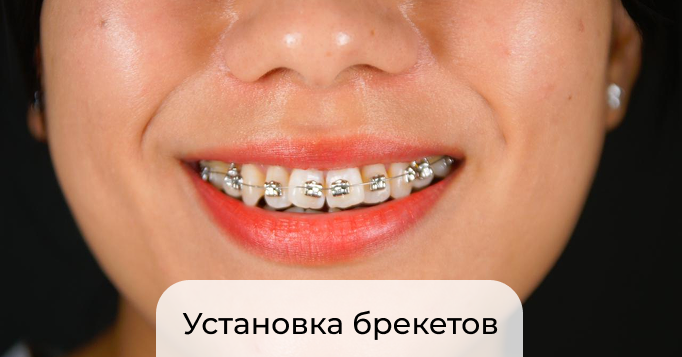 Исправление прикуса